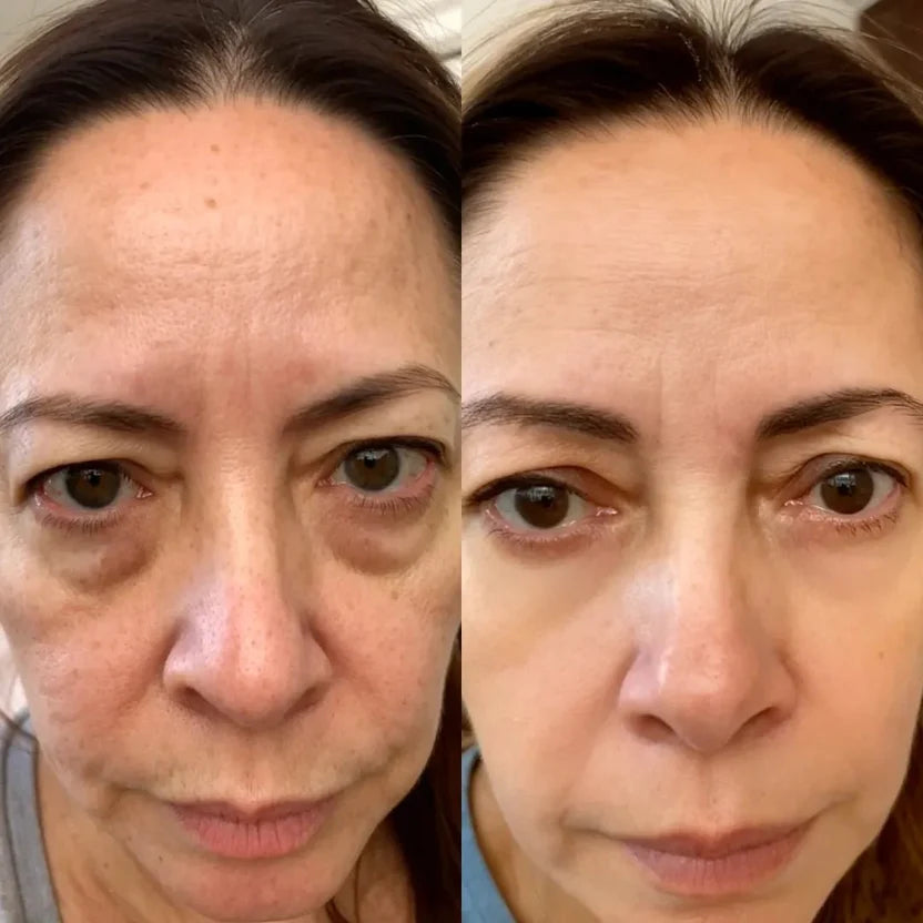 Bag Eye Rest™   Luz y Masaje para Eliminar Bolsas y Ojeras.